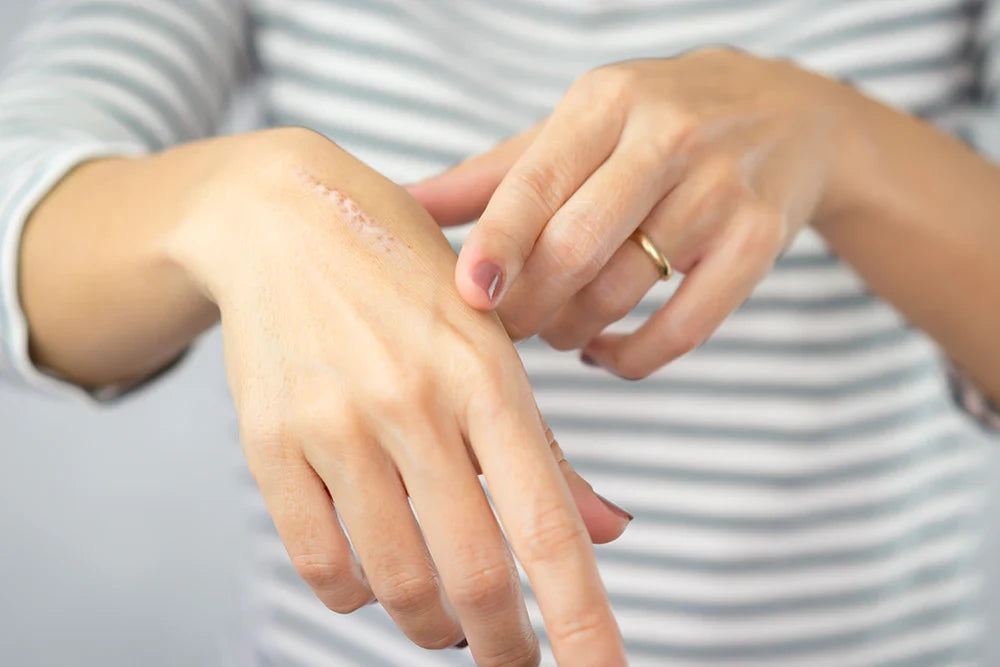 silicone scar sheets for healing
