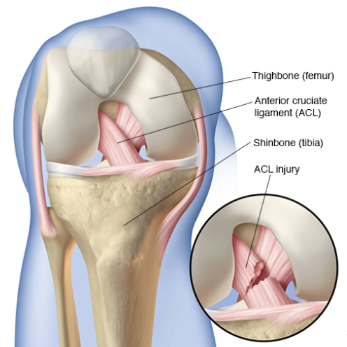 Road to Recovery: ACL Injury and Surgery, Part 1