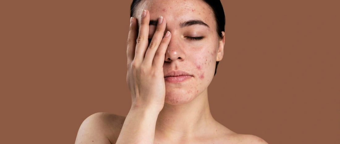 Surprising Reasons for Acne