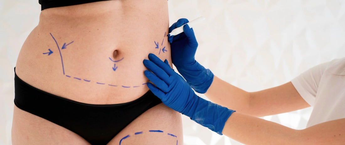 Exposed tummy of a woman with tummy tuck marks