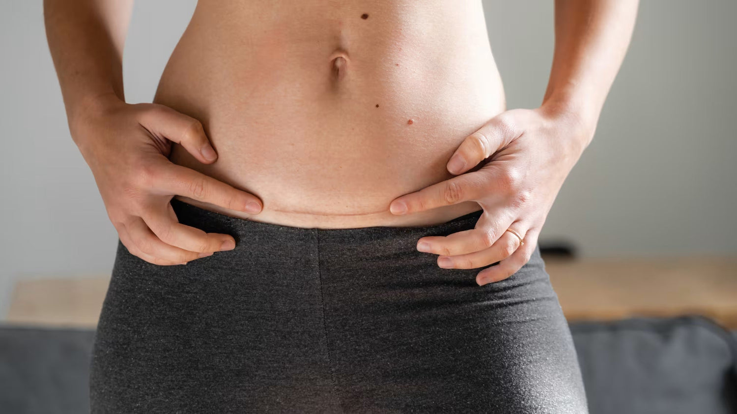 Dimethicone for scar healing