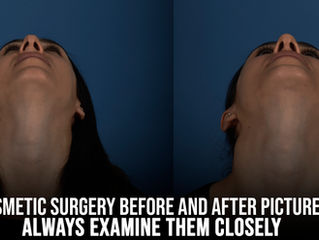 Examining Cosmetic Surgery Before & After Pictures
