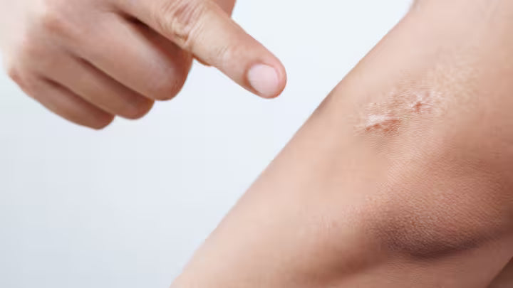 Fibroblasts in Surgical Scar