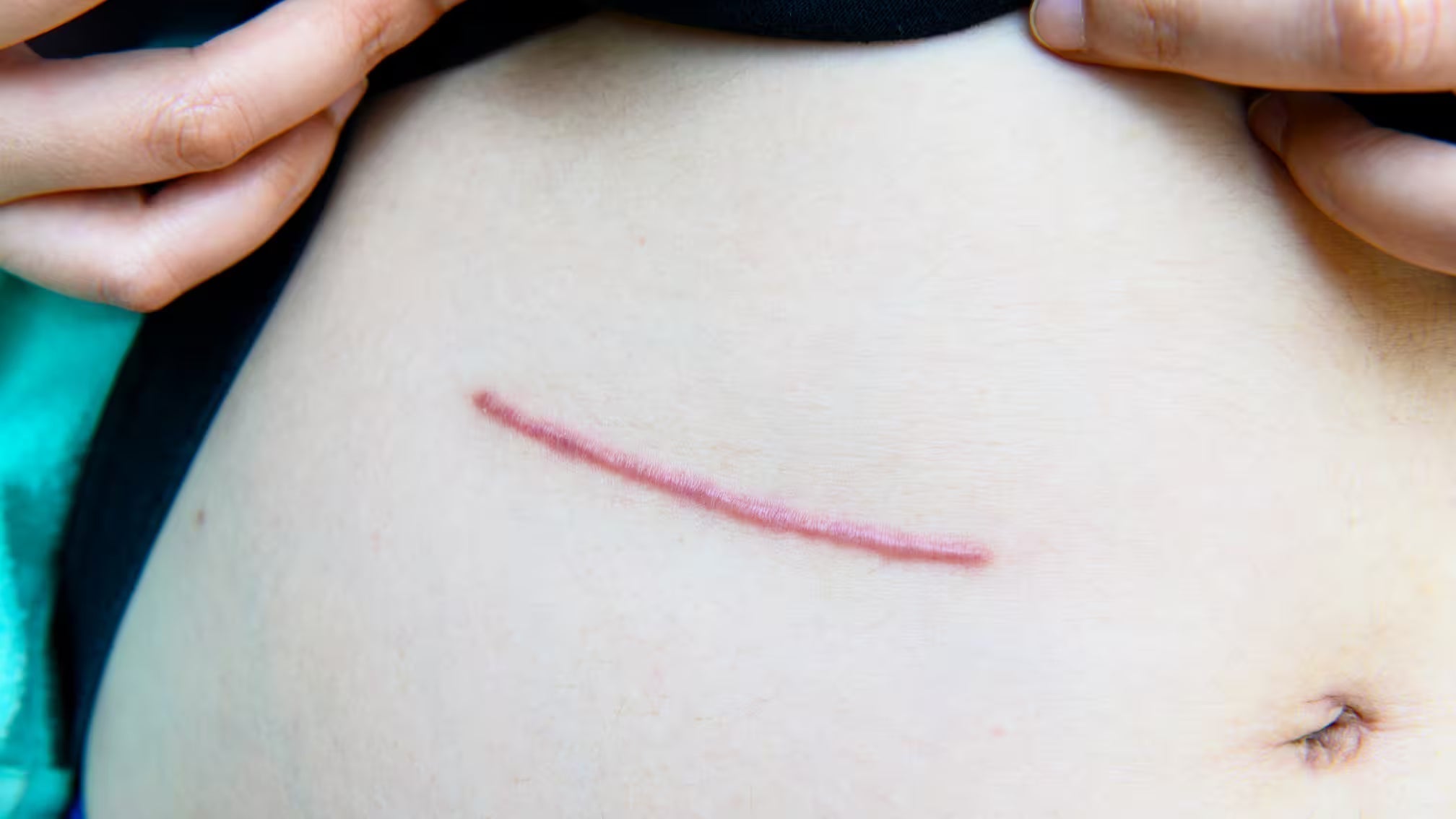 Why Do Surgical Scars Feel Lumpy? Is It Normal? – HealFast