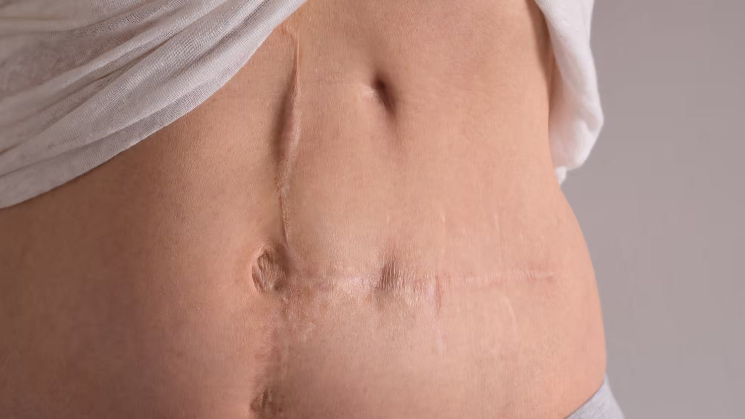 Scar Care After Surgery