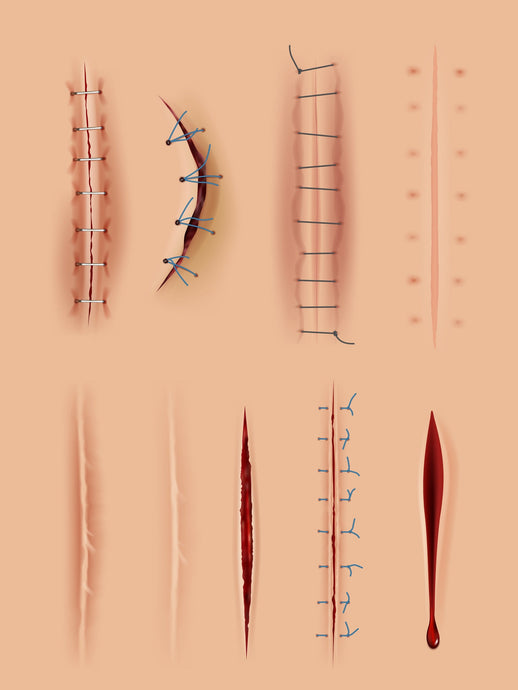 Does Silicone Help Scars Heal?