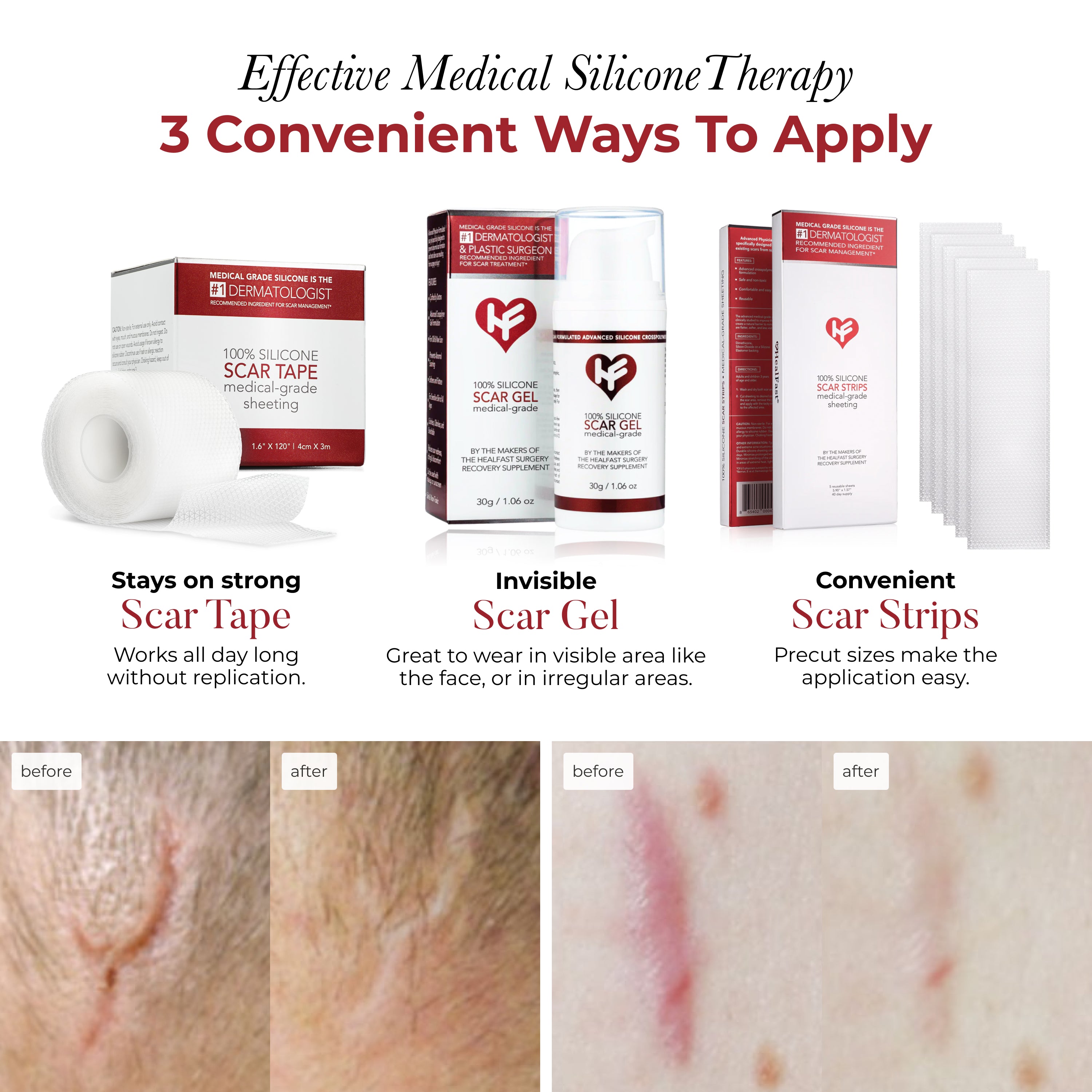 Medical Grade Scar Sheeting: Tape